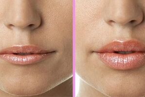 sebelum dan selepas prosedur pemulihan bibir